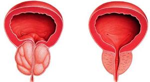 the difference in the sick and healthy of the prostate gland
